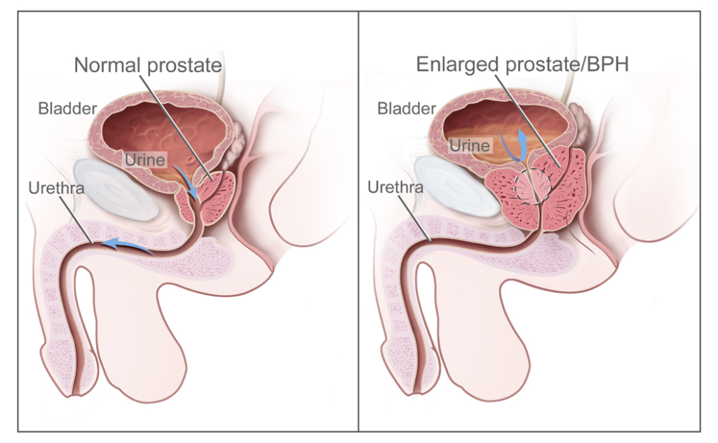 benign prostatic hyperplasia